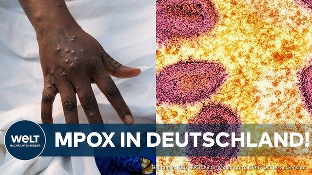 MPOX: RKI meldet ersten Fall der neuen Affenpocken-Variante in Deutschland